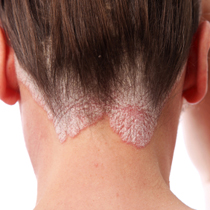 Psoriasis i hårbunden kan være meget synligt, men ikke altid