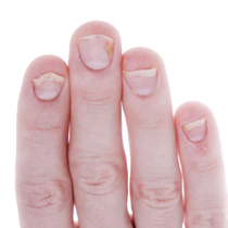 symptomer på Psoriasis på neglene kan være at neglene løsner sig