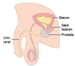 prostata, kræft